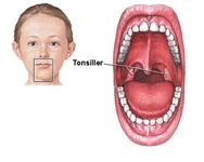 Çoçuklarda Geniz Eti Büyümesi Tedavisi